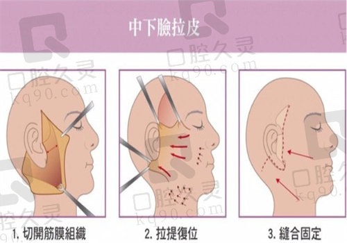 拉皮手术流程图