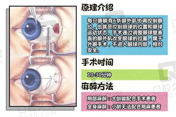 斜视手术介绍