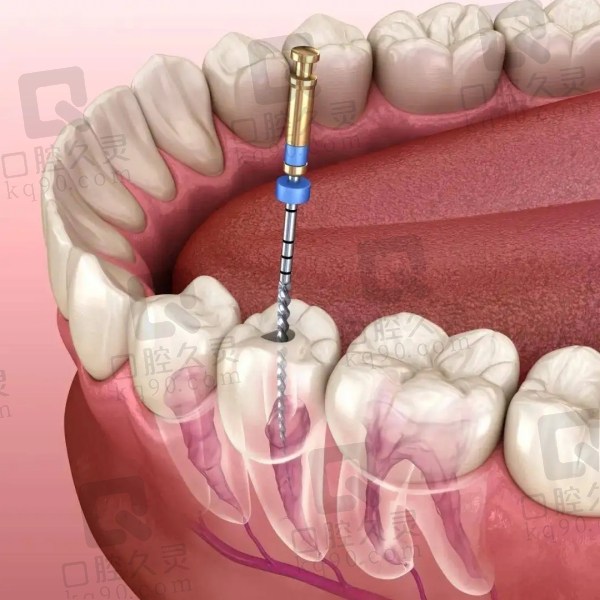 西安根管治疗哪个医院好