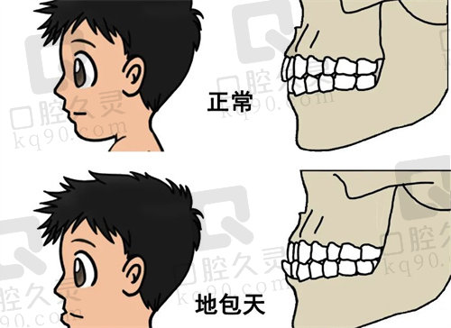 青岛地包天牙齿矫正