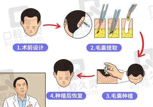 毛囊移植手术流程