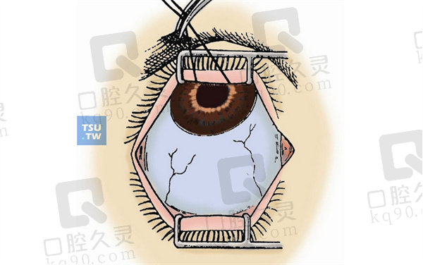 后巩膜加固手术是微创手术吗？