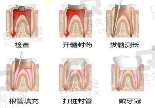 根管治疗痛不痛