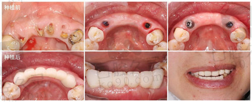 我在深圳美奥口腔医院种植牙前后对比