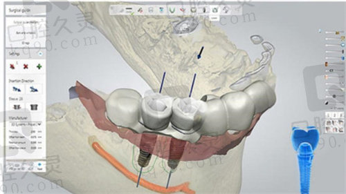 深圳美奥口腔医院数字化种植牙技术