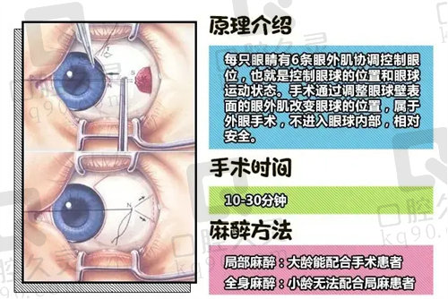 济南华视眼科医院斜视手术图示