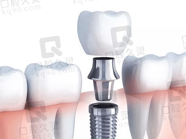 成都团圆口腔医院瑞士士卓曼ITI种植牙5490元起