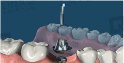 合肥中诺口腔种植牙怎么样