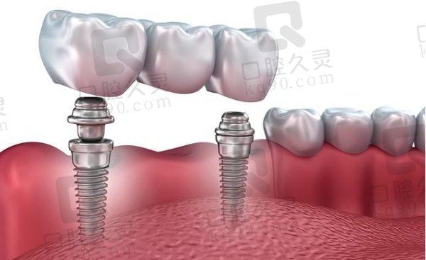 北京海德堡口腔医院种植牙价格表