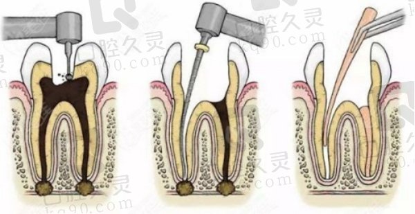 东莞好佰年口腔根管治疗优势