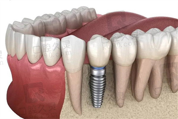 种植牙植骨后要几天才能消肿