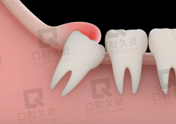 南宁诺贝尔口腔微创拔牙的优势