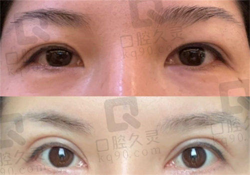 成都画美医疗美容医院黄元利双眼皮事例