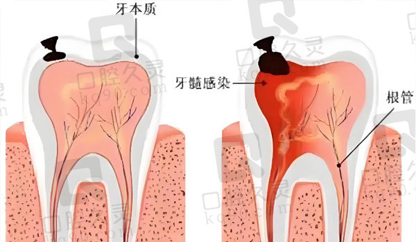 根管治疗问题