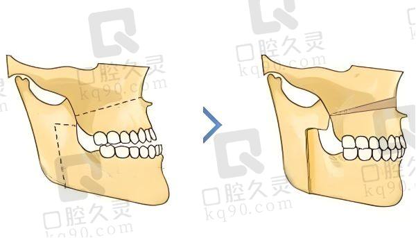 地包天矫正的过程