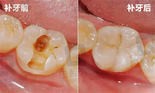 柳州华心口腔门诊部补牙