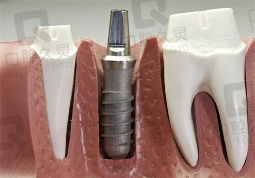 洛阳九龙口腔医院种植牙价格不贵