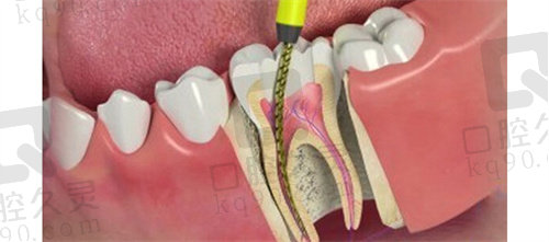 扬州牙管家口腔根管治疗价格