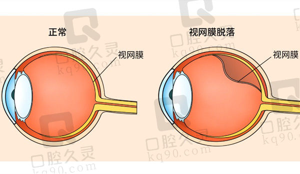 视网膜破裂是什么原因造成的