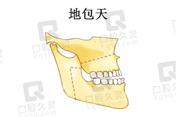 地包天怎么看是骨性还是牙性