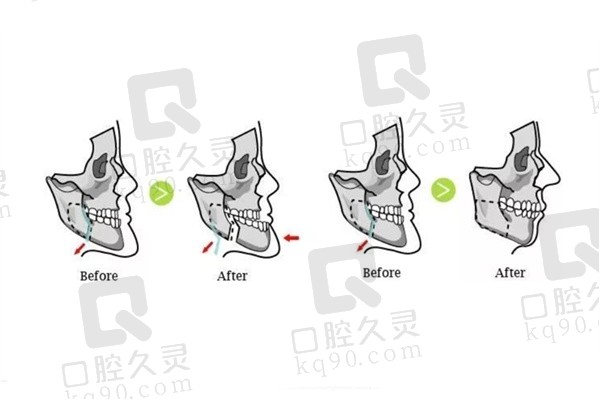 地包天怎么看是骨性还是牙性