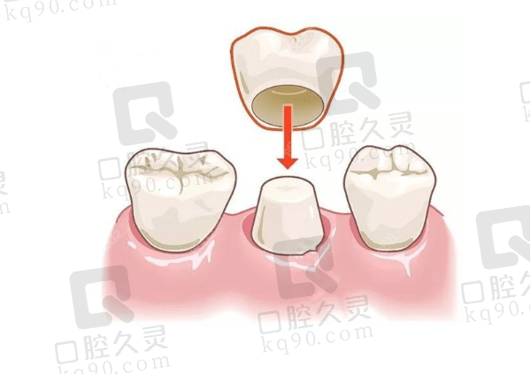 广州穗华口腔医院做全瓷冠后维护指南