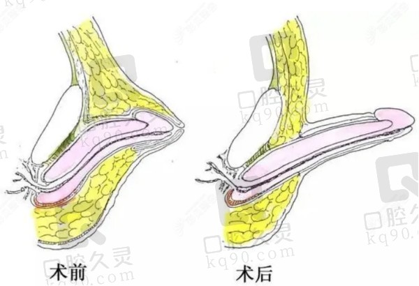 重庆星荣整形外科医院李世荣做男性私密整形技术优势