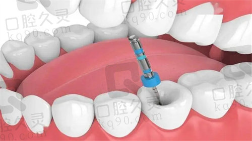 吉林市张杰口腔门诊部根管治疗