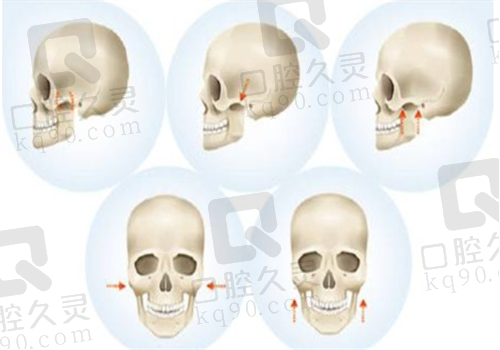 上海华美做下颌角怎么样