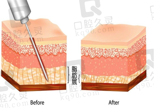 上海华美做脂肪填充怎么样