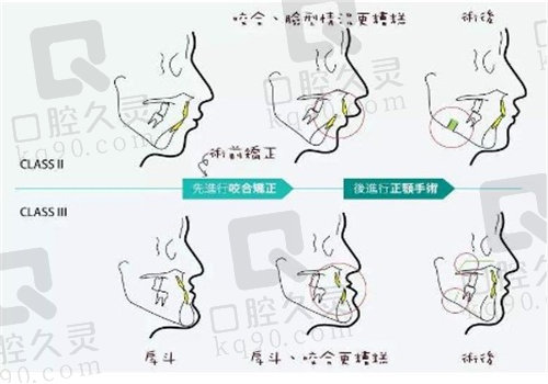 周会喜正颌手术做的怎么样？