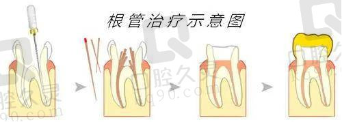 宁波恒美口腔医院根管治疗价格