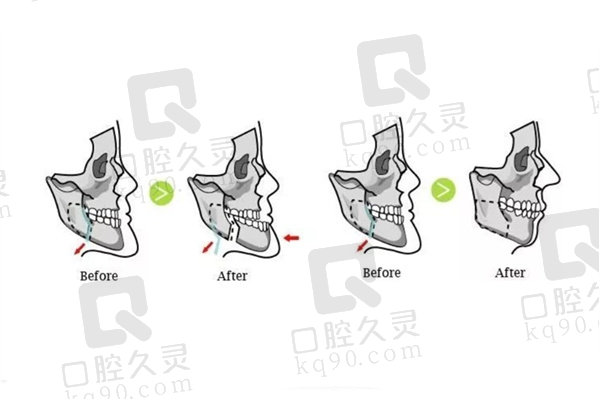 正颌手术算整容吗？