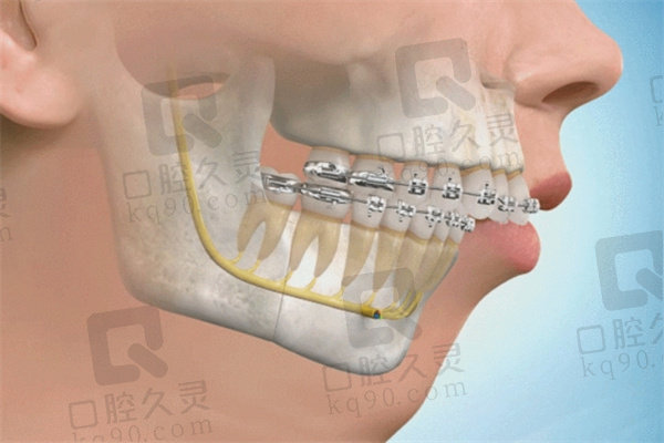 正颌手术能改变脸型吗？