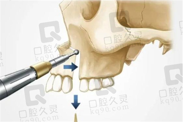 正颌手术能改变脸型吗？