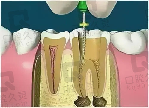 乌鲁木齐美奥口腔医院根管治疗的优势