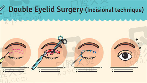 郑州聂丽丽修复双眼皮怎么样？