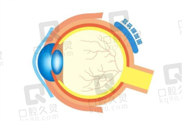 后巩膜加固术能治疗近视吗