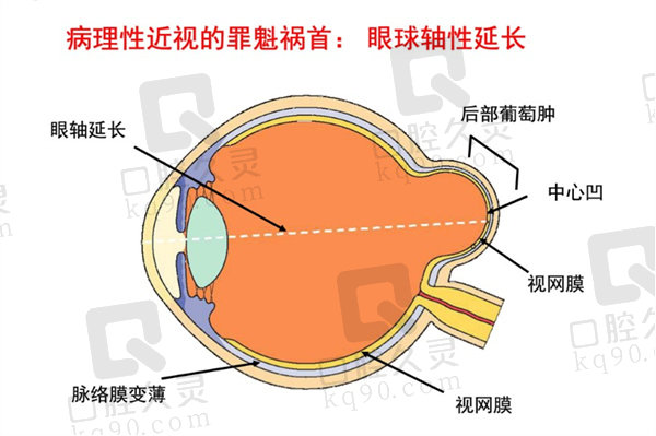 后巩膜加固术的利弊