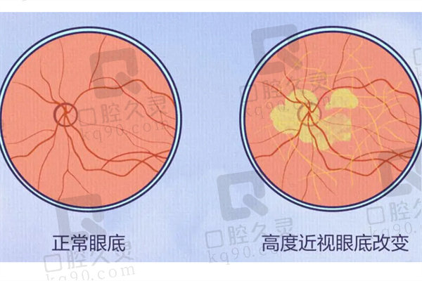 后巩膜加固术大概费用