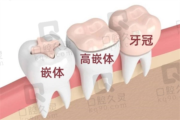 牙冠和嵌体哪个实用性强