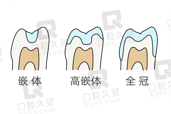 牙冠和嵌体哪个实用性强