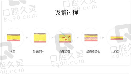 成都哪家医院吸脂后不用穿塑身衣？