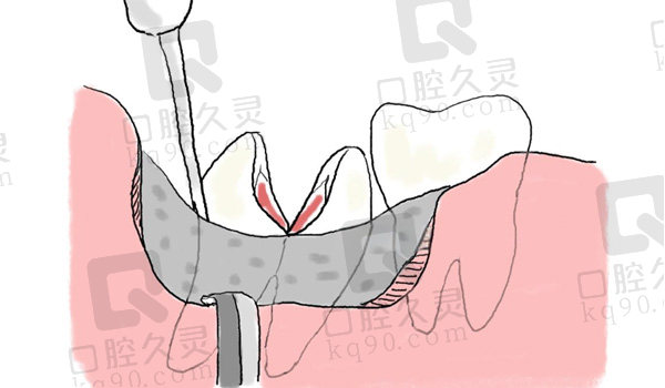 智齿拔除