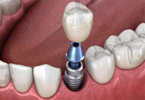 广州鼎植口腔瑞士ITI种植牙价格