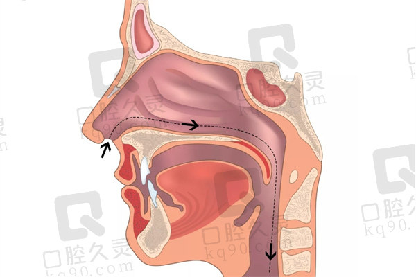 口呼吸脸型能长回去吗