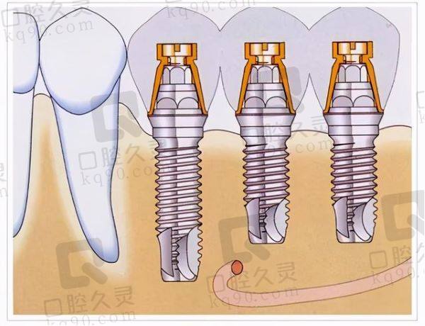 昆明德系口腔韩国仕诺康种植牙怎么样