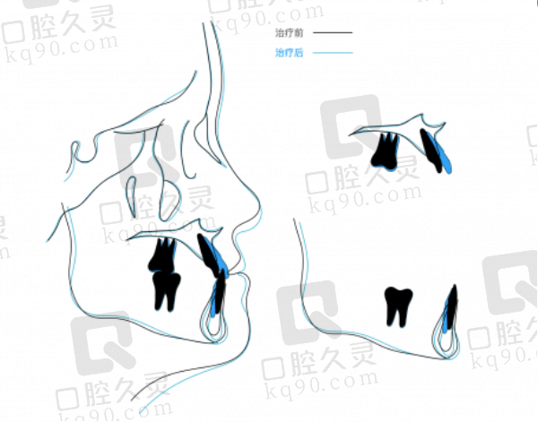 预约上海易美口腔林晓松医生做矫正