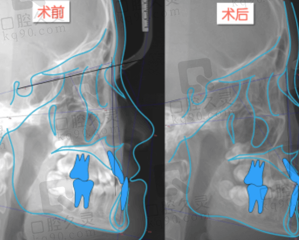 我在上海易美口腔做地包天矫正的过程