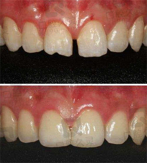 在成都锦江极光做了门牙缝填补术后对比